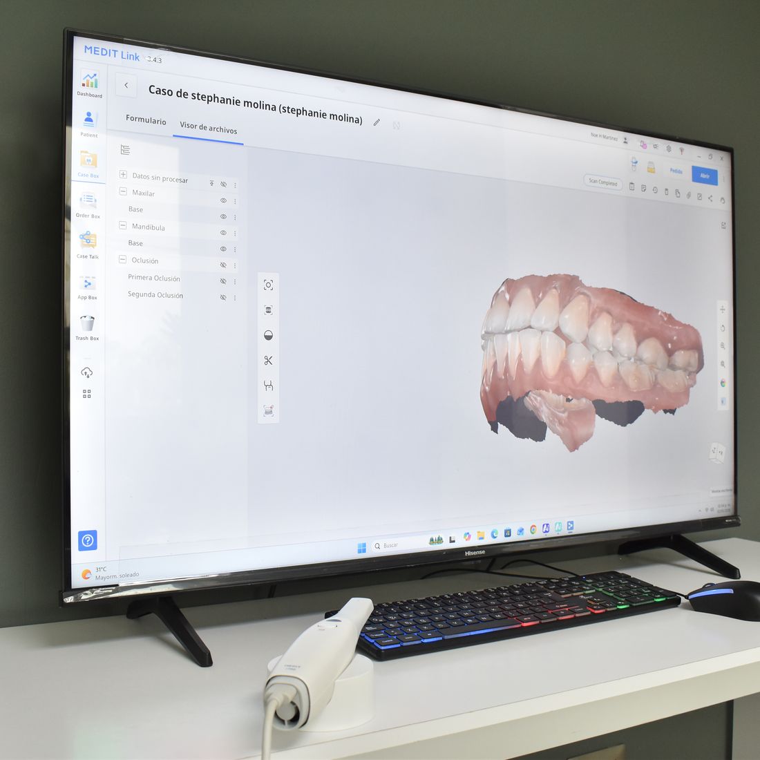 Escáner intraoral digital y el modelo 3D de la dentadura de un paciente en pantalla